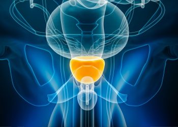 Διαδερμικά επιθέματα οιστραδιόλης στον τοπικά προχωρημένο καρκίνο του προστάτη