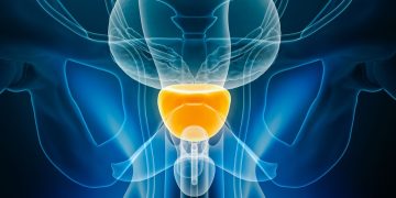 Διαδερμικά επιθέματα οιστραδιόλης στον τοπικά προχωρημένο καρκίνο του προστάτη