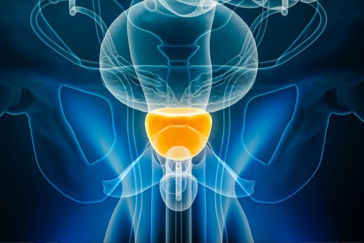 Διαδερμικά επιθέματα οιστραδιόλης στον τοπικά προχωρημένο καρκίνο του προστάτη