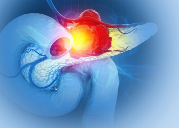 Καρκίνος του παγκρέατος