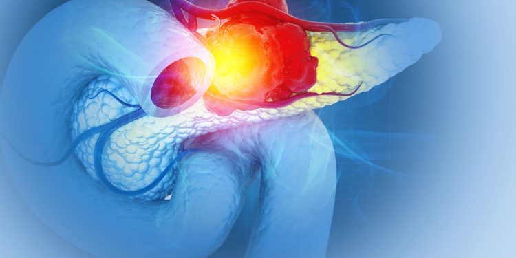 Καρκίνος του παγκρέατος