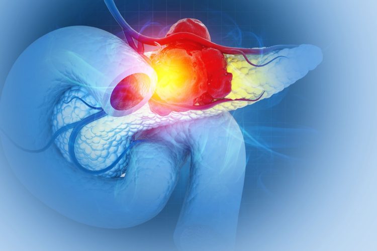 Καρκίνος του παγκρέατος