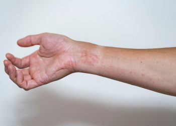 Μπορούν να θεραπευτούν τα αυτοάνοσα; Η περίπτωση της γυναίκας που αλλάζει τα δεδομένα