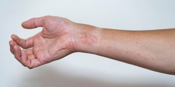 Μπορούν να θεραπευτούν τα αυτοάνοσα; Η περίπτωση της γυναίκας που αλλάζει τα δεδομένα