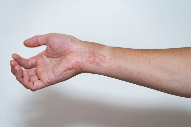 Μπορούν να θεραπευτούν τα αυτοάνοσα; Η περίπτωση της γυναίκας που αλλάζει τα δεδομένα