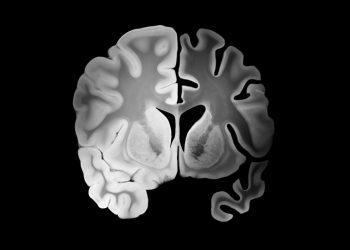 Στην Κρήτη το πρώτο φάρμακο για το Αλτσχάιμερ