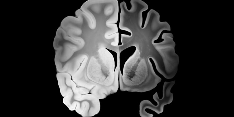 Στην Κρήτη το πρώτο φάρμακο για το Αλτσχάιμερ