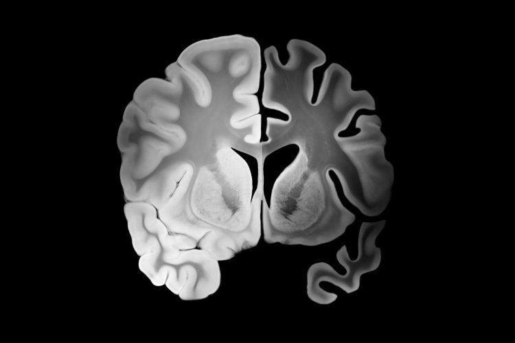 Στην Κρήτη το πρώτο φάρμακο για το Αλτσχάιμερ