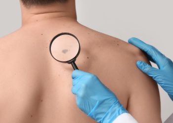 Ο μήνας Μάιος έχει καθιερωθεί ως μήνας ευαισθητοποίησης για το μελάνωμα