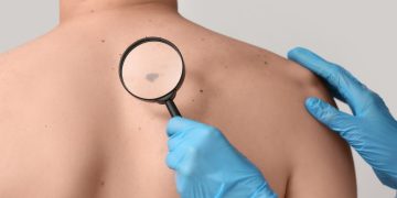 Ο μήνας Μάιος έχει καθιερωθεί ως μήνας ευαισθητοποίησης για το μελάνωμα
