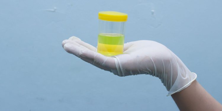 Μια απλή εξέταση ούρων ίσως αλλάξει το μέλλον της ψυχιατρικής διάγνωσης
